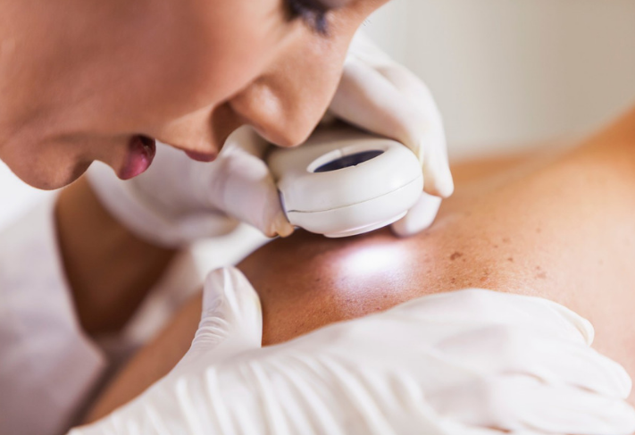 dermatologue dépistage mélanome